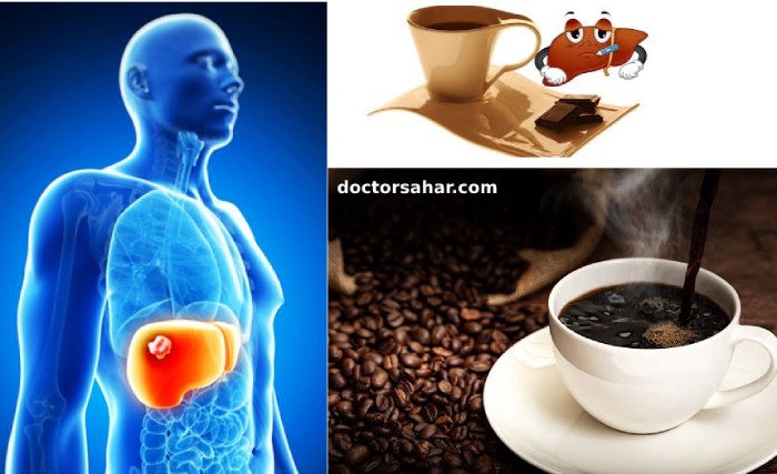 نوشیدن قهوه یک درمان کبد چرب